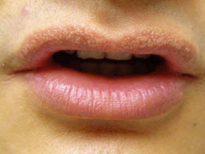 Bumps On Lips Causes Types Symptoms Treatment Prevention And More Healthroid 8653