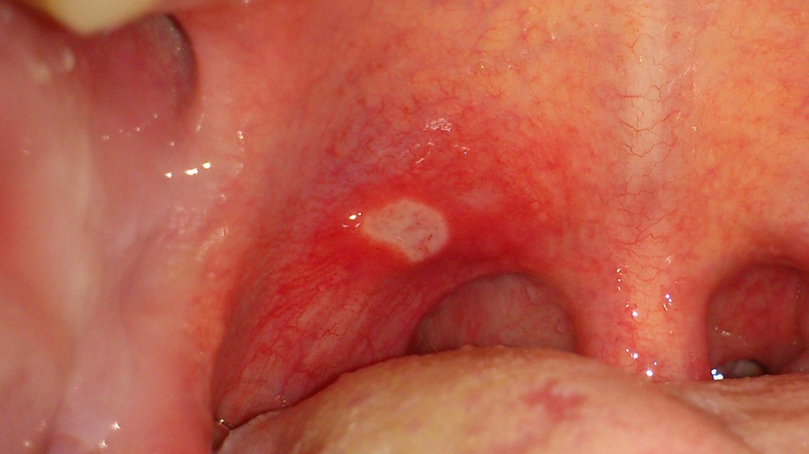 Throat Ulcer Causes Symptoms Diagnosis Treatment Prevention 