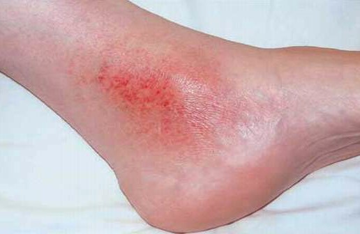 Ankle Rash Causes Symptoms Diagnosis Treatment Prevention And More