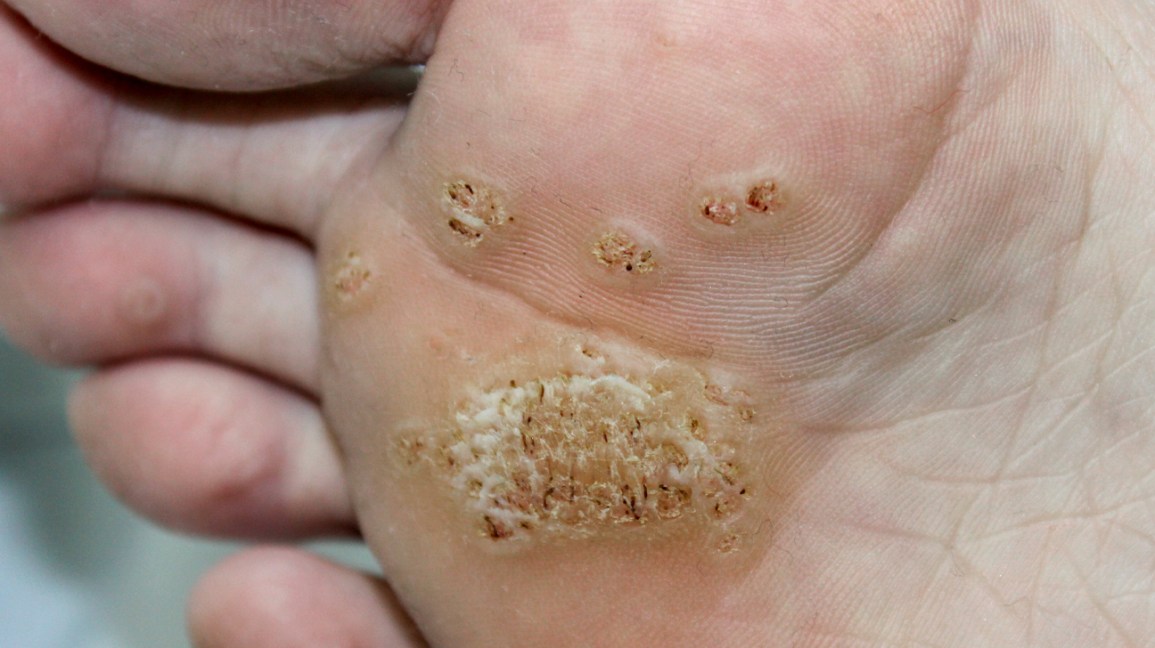 Plantar Warts Causes, Symptoms, Diagnosis, Treatment, Prevention